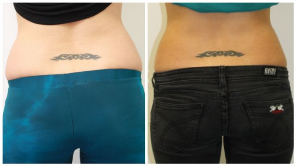 Late 20s, series of 4 Exilis treatments to tummy and love handle area.