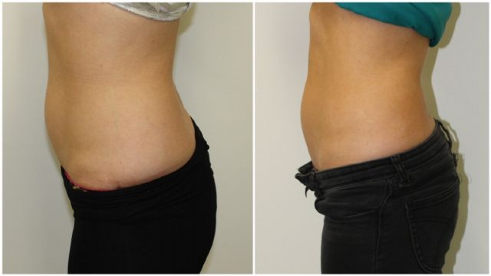 Late 20s, series of 4 Exilis treatments to tummy and love handle area.