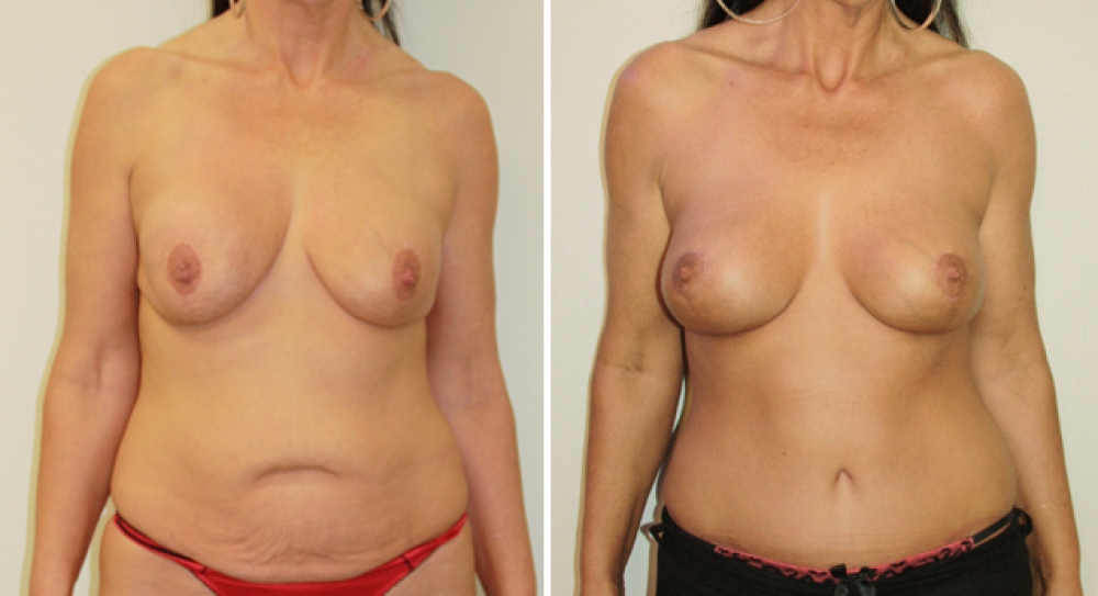Late 40's, 3 children, removal of existing breast implants to improve shape, combined with a full tummy tuck procedure to restore contour and cosmetic appearance.