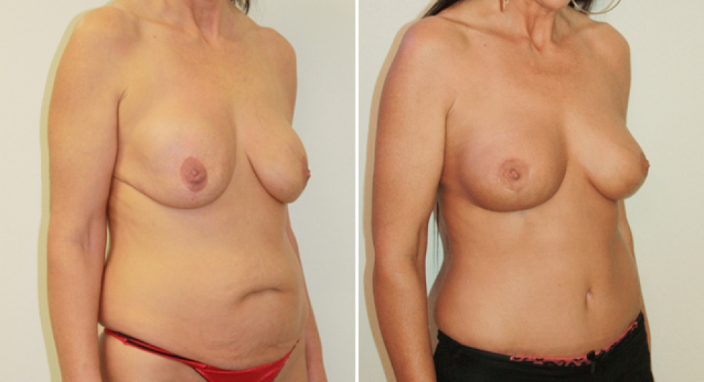 Late 40's, 3 children, removal of existing breast implants to improve shape, combined with a full tummy tuck procedure to restore contour and cosmetic appearance.
