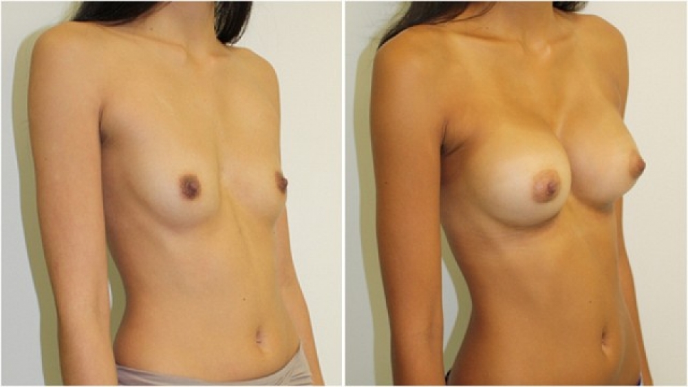 Mid 20's, no children, 315g anatomic moderate profile implants, dual plane 2 placement. B->D cup.