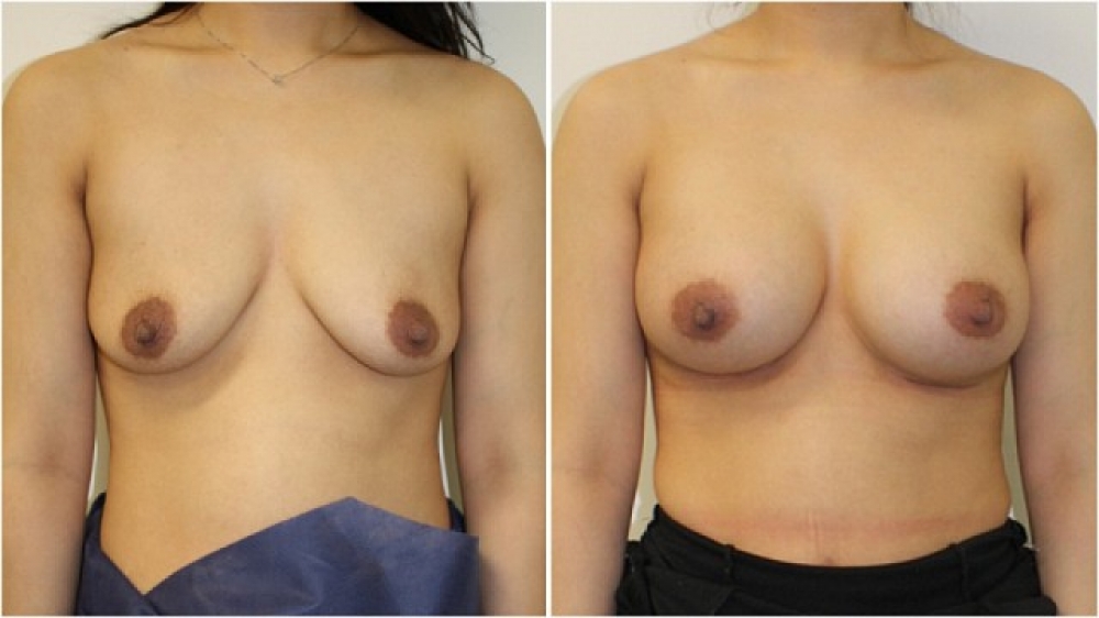 Late 20's, 2 children, moderate droop, 325g anatomical (teardrop) high profile implants, dual plane 3 placement, natural looking A->full C cup.