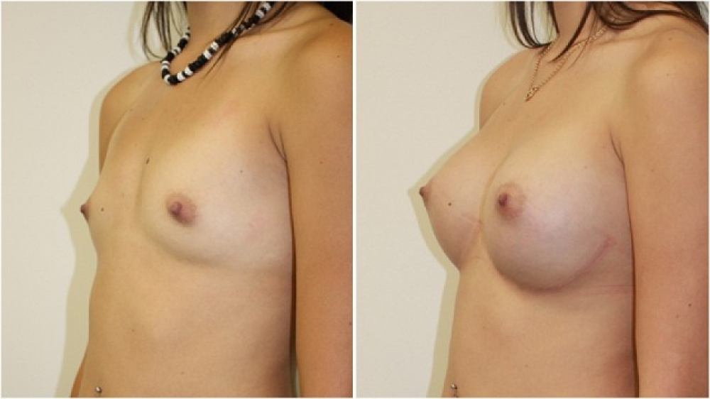 19yo, no children, 335g round high profile textured implants, dual plane 2 placement, A-> C cup.