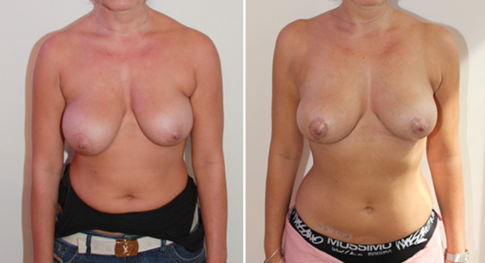 Mid 20s, no children, bilateral breast reduction and nipple reshaping performed to correct symmetry and shape of breasts with 40g of tissue removed from right breast and 23g from left.