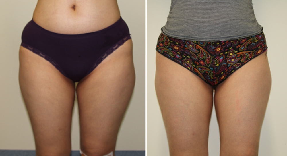 Mid 20s, series of 4 exilis treatments to left and right thighs, resulting in a significant decrease in measurements.