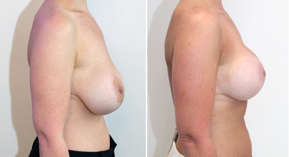 40 yo, 1 child, revision breast augmentation, reshaping and implant change. This lady had her breasts distorted over time by her implants of many years. New 360g textured round implants have been combined with her reshaping/lifting procedure.