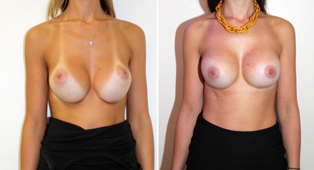 Late 20s, previous breast augmentation performed elsewhere. This patient demonstrates the phenomenon of implant 'bottoming out'. Corrective breast augmentation surgery performed by Dr Miroshnik to restore implants to their correct place.
