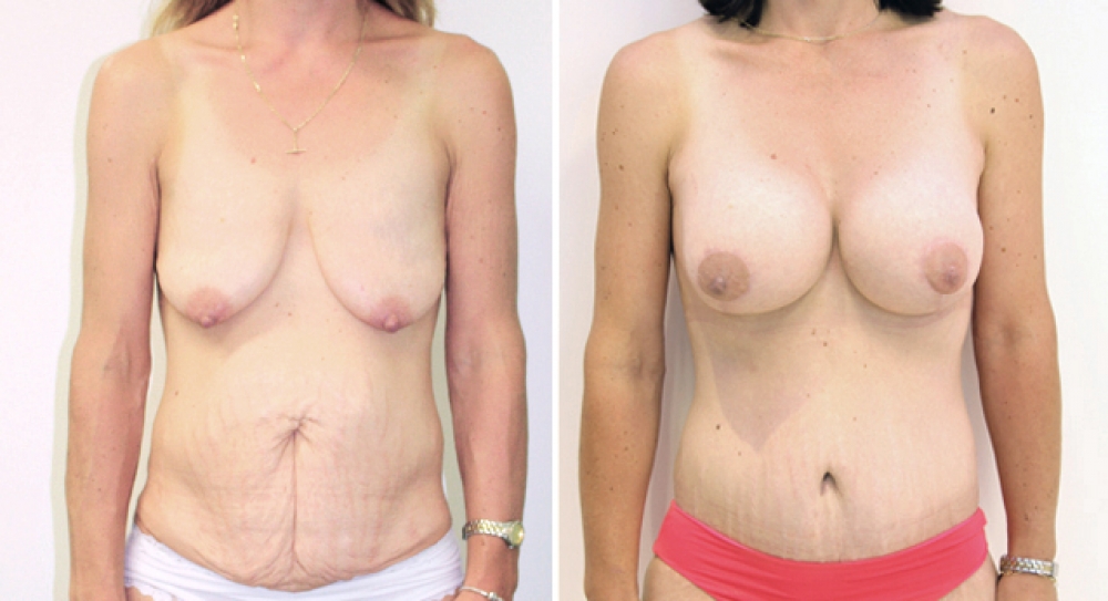 Late 30s, 4 children, full abdominoplasty combined with bilateral augmentation mastopexy (implants+lift) using 365g textured, round implants, with subfascial placement.
