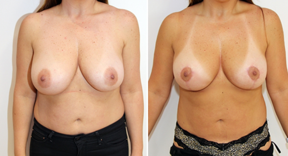 40 yo, 1 child, bilateral breast lift/reduction performed with 82g of breast tissue removed from right and 38g removed from left breast to improve breast position and shape.