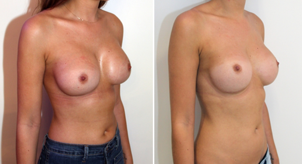 Early 30's, original augmentation surgery performed elsewhere. Removal/capsulectomy and replacement of both breast implants using 360g textured, round implants.