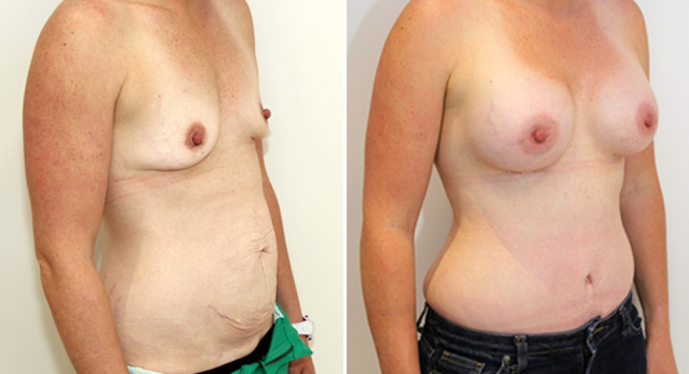 31yo, 3 children, full tummy tuck combined with breast augmentation performed using 440g anatomical (teardrop) implants with dual plane 3 placement.