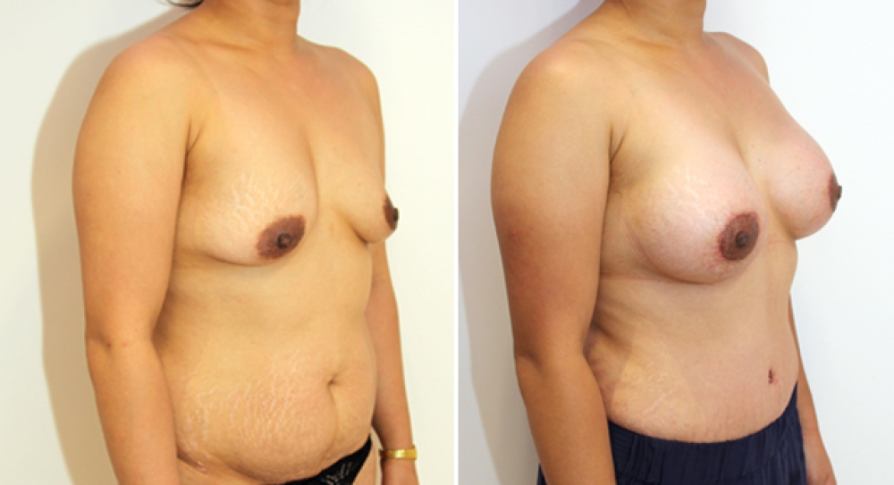 29yo, 2 children, full tummy tuck combined with breast augmentation and periarelor lift using 385g round implants with subfascial placement.