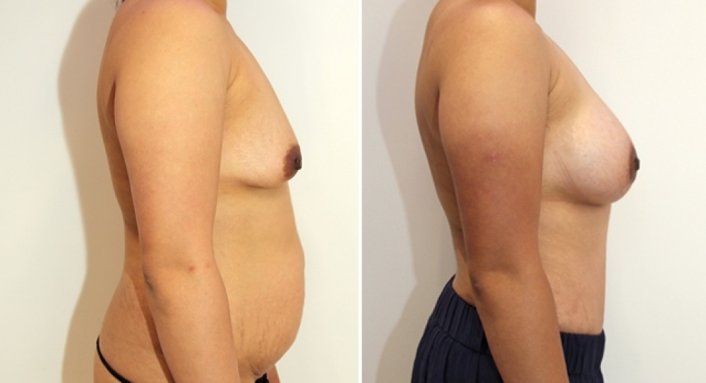 29yo, 2 children, full tummy tuck combined with breast augmentation and periarelor lift using 385g round implants with subfascial placement.