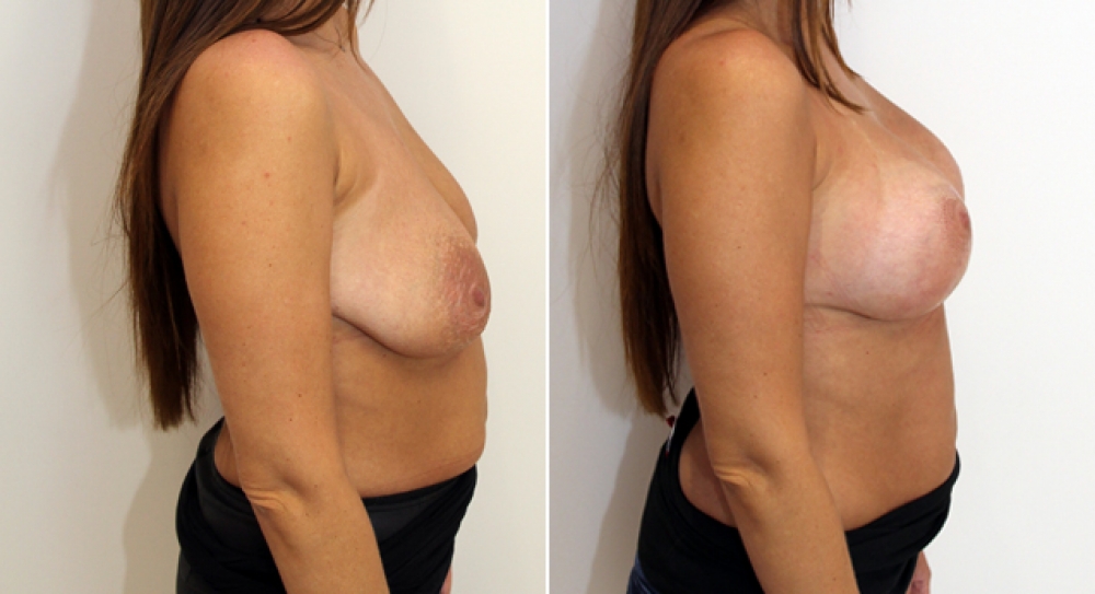 Late 30s, breastfed, augmentation mastopexy (breast lift and implants) with round 385g implants.