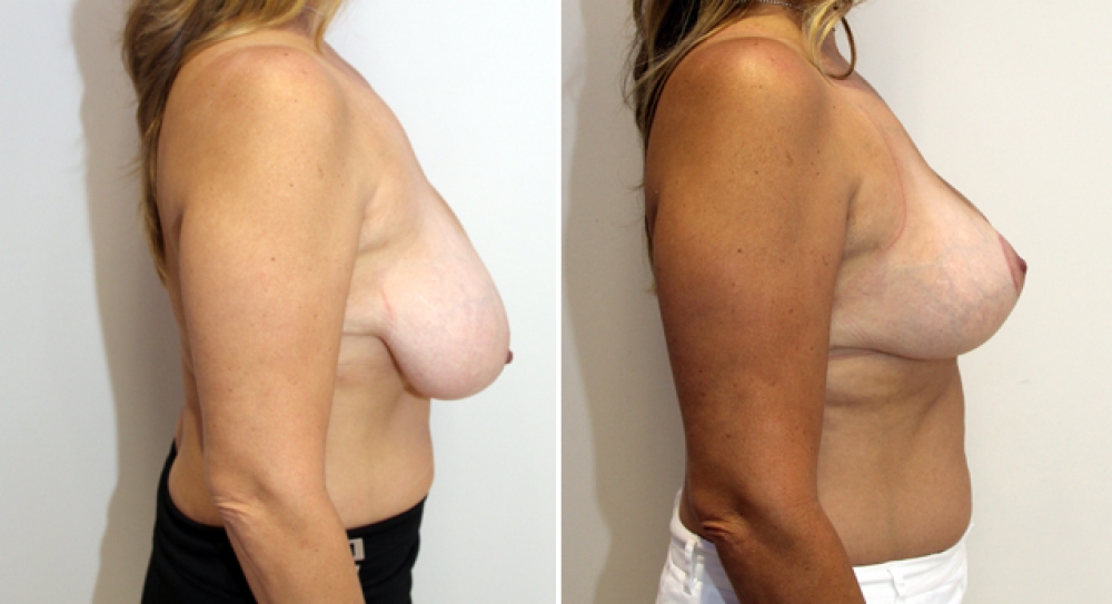 Mid 40s, 3 children, vertical short-scar breast reduction and lift with nipple repositioning and reshaping. Approximately 345g of tissue removed from left and 375g from right breast.
