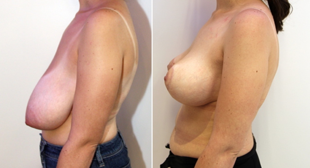 29 yo, no children, bilateral breast lift/reduction performed with approx 310g of breast tissue removed from left and 275g removed from right breast to correct symmetry and shape of breast.