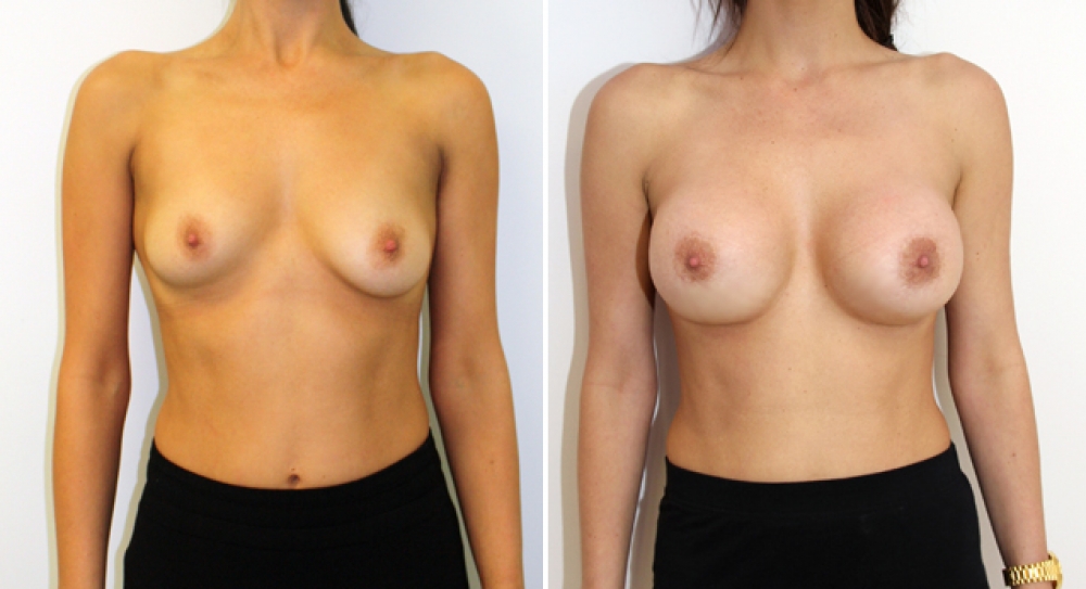 Mid 20s, mild bilateral tuberous breasts corrected/augmented with 390g anatomic implants and periareolar approach.