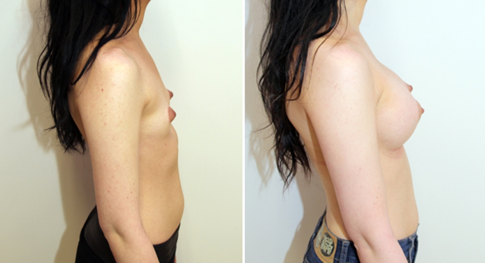 Mild bilateral tuberous breasts corrected with augmentation and parenchymal scoring.