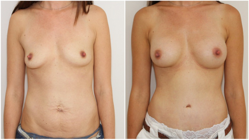 215g subfascial breast augmentation combined with muscle tightening tummy tuck.