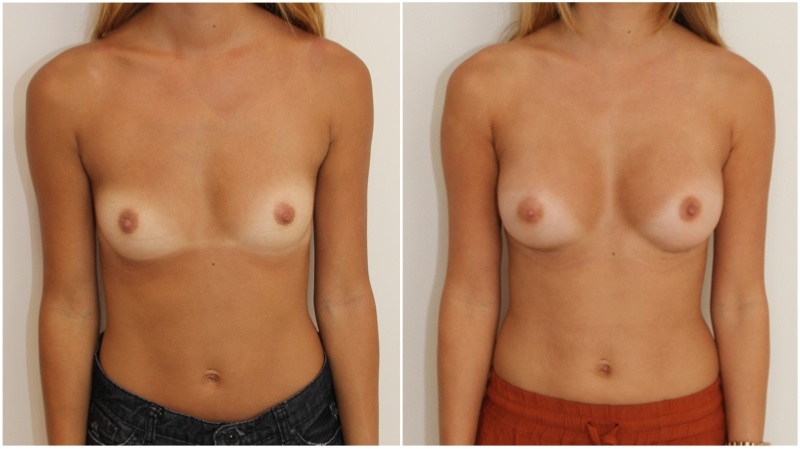 20s, 245g moderate profile anatomic, dual plane placement.