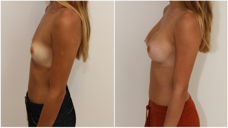 20s, 245g moderate profile anatomic, dual plane placement.