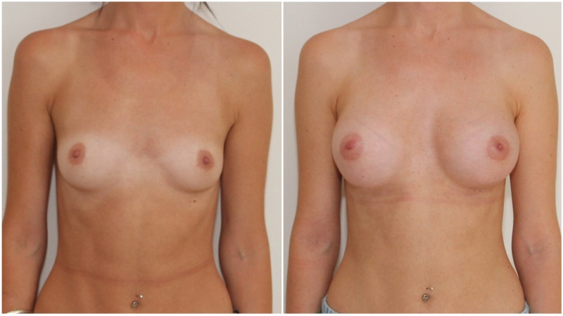 Subtle style enhancement by Dr M using 255g/295g cohesive anatomical implants to also correct asymmetry.