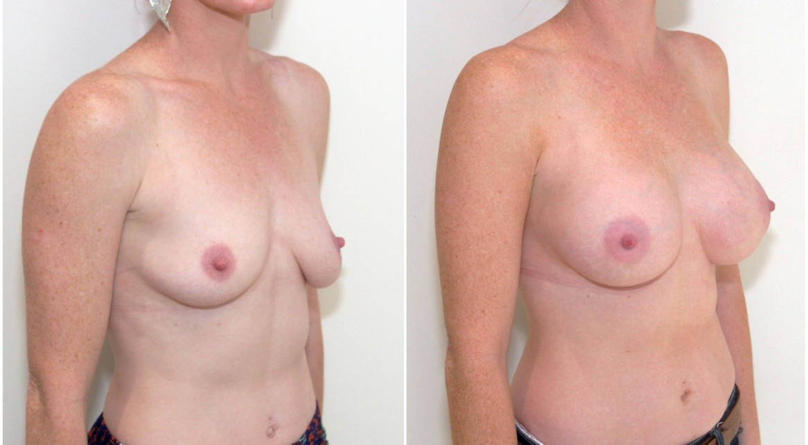 Breast droop and asymmetry corrected with a 275g mod profile breast augmentation coupled with a breast lift on the left side only to match.