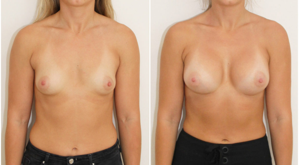 Grade 1 Tuberous with asymmetry corrected with 280cc right and 295cc left anatomics, dual plane.