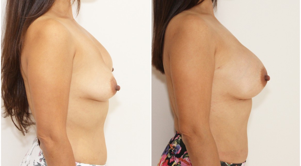 Deflated saline implants removed and replaced with 295g anatomics.