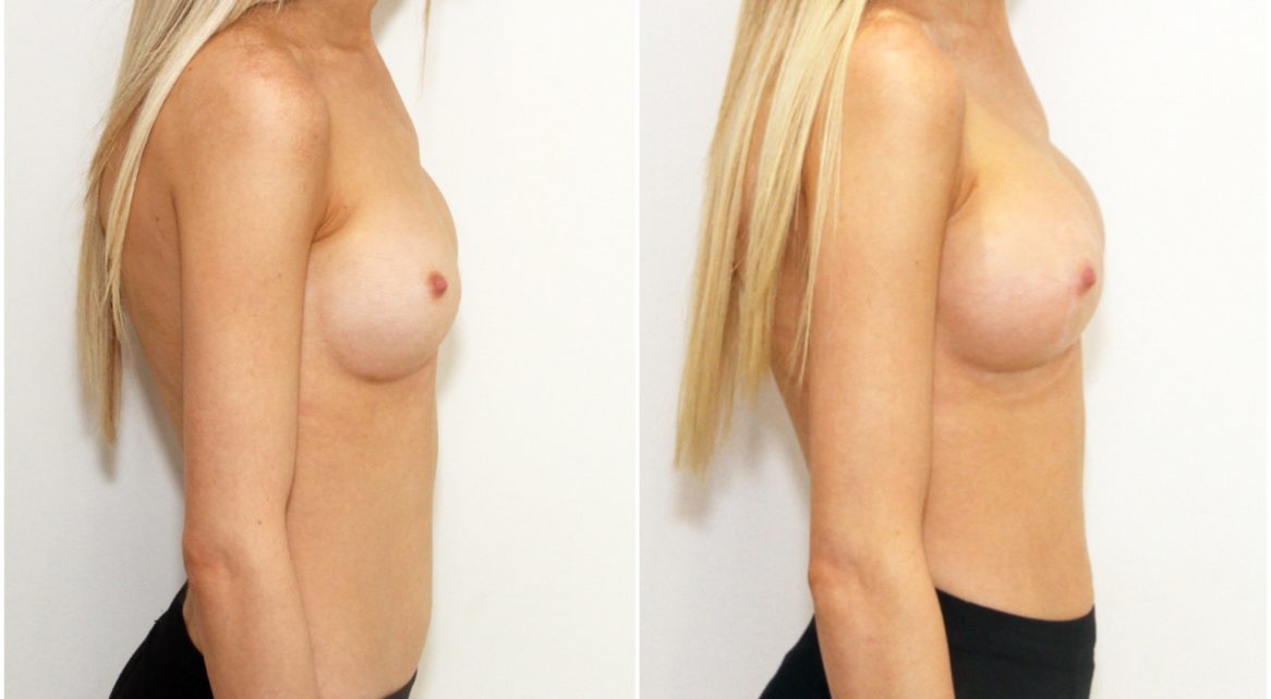 Bottoming out right breast implant corrected with bilateral removal and replacement of implants / internal bras and capsular flaps.