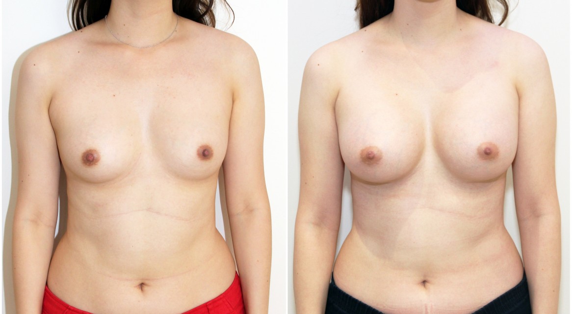 20s, 410g full projection anatomical implants, submuscular placement.