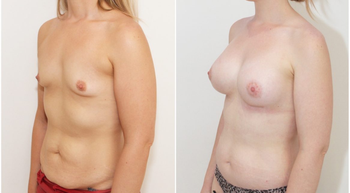 Full abdominolioplasty combined with 420cc anatomical breast augmentation