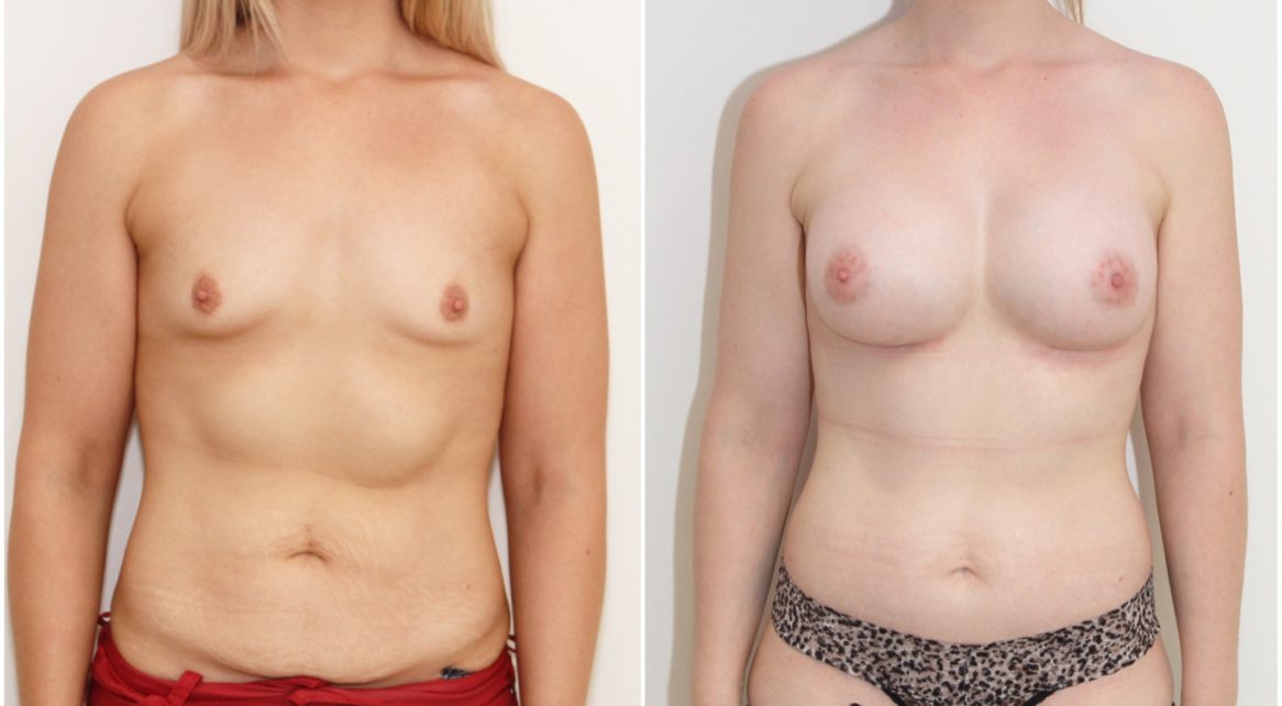 Full abdominolioplasty combined with 420cc anatomical breast augmentation