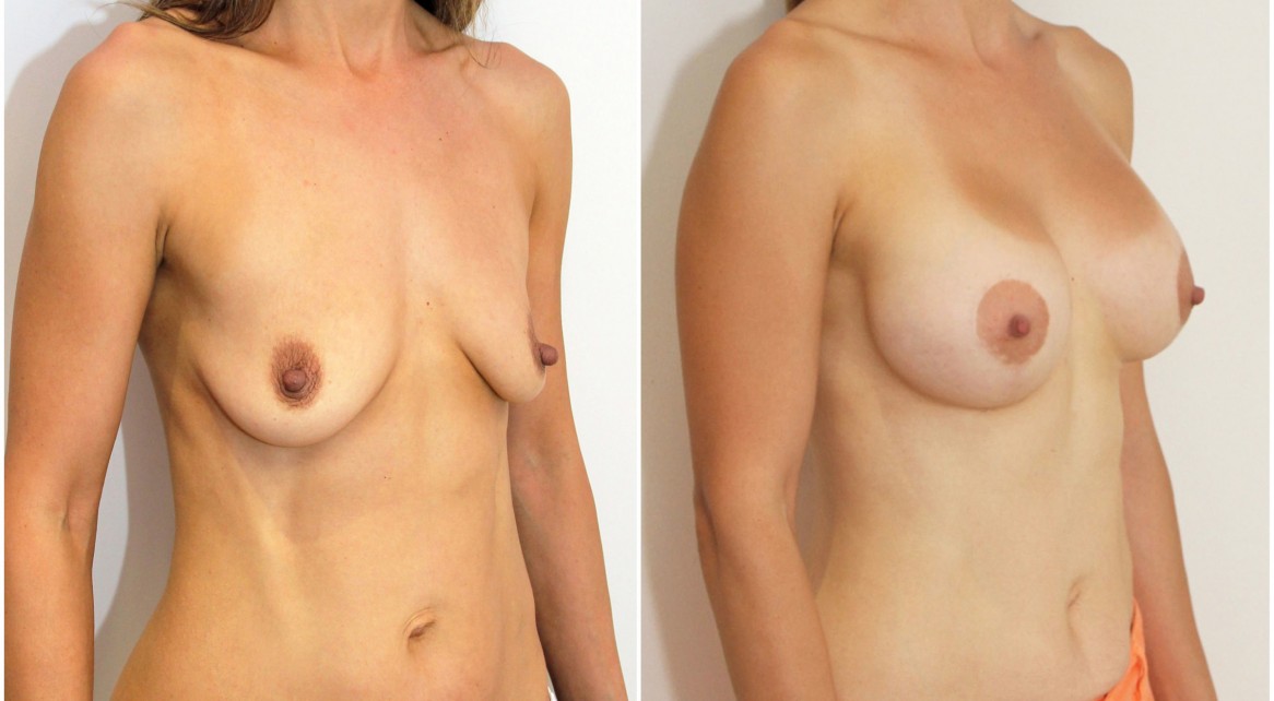 30s, children, vertical breast lift + implants (425cc round ,high profile).