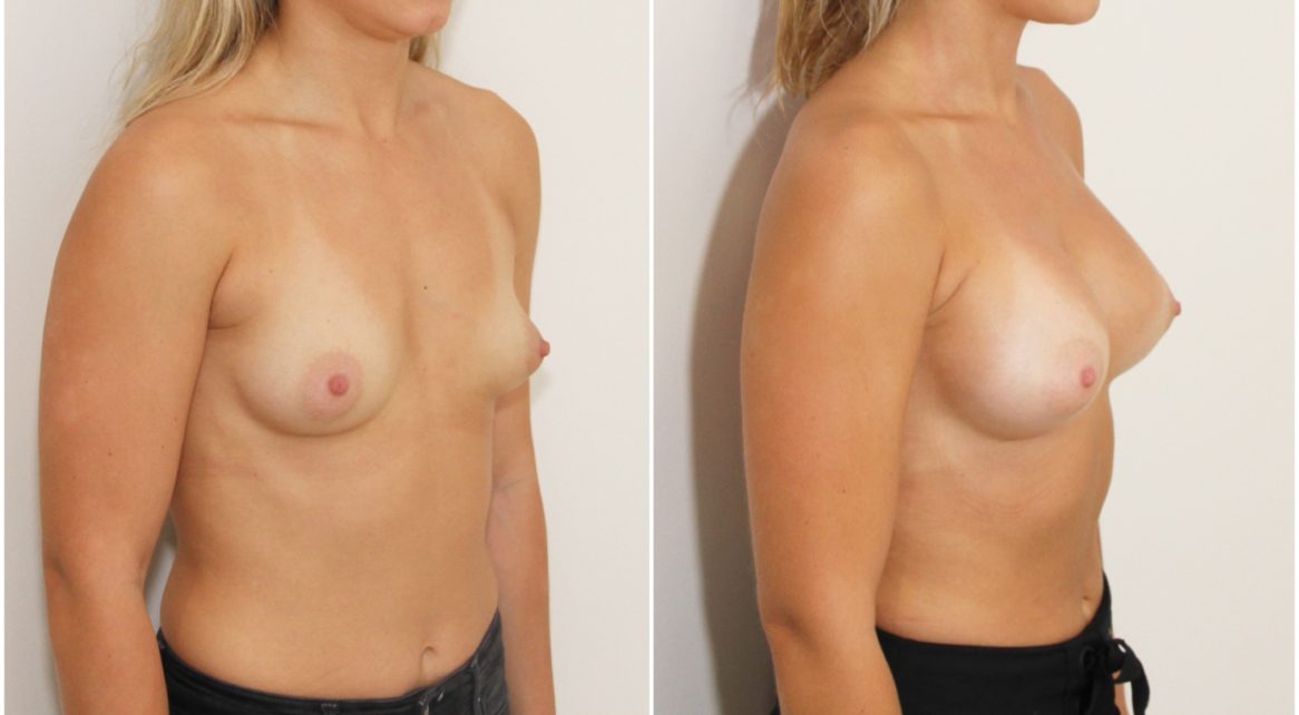 Grade 1 Tuberous with asymmetry corrected with 280cc right and 295cc left anatomics, dual plane.