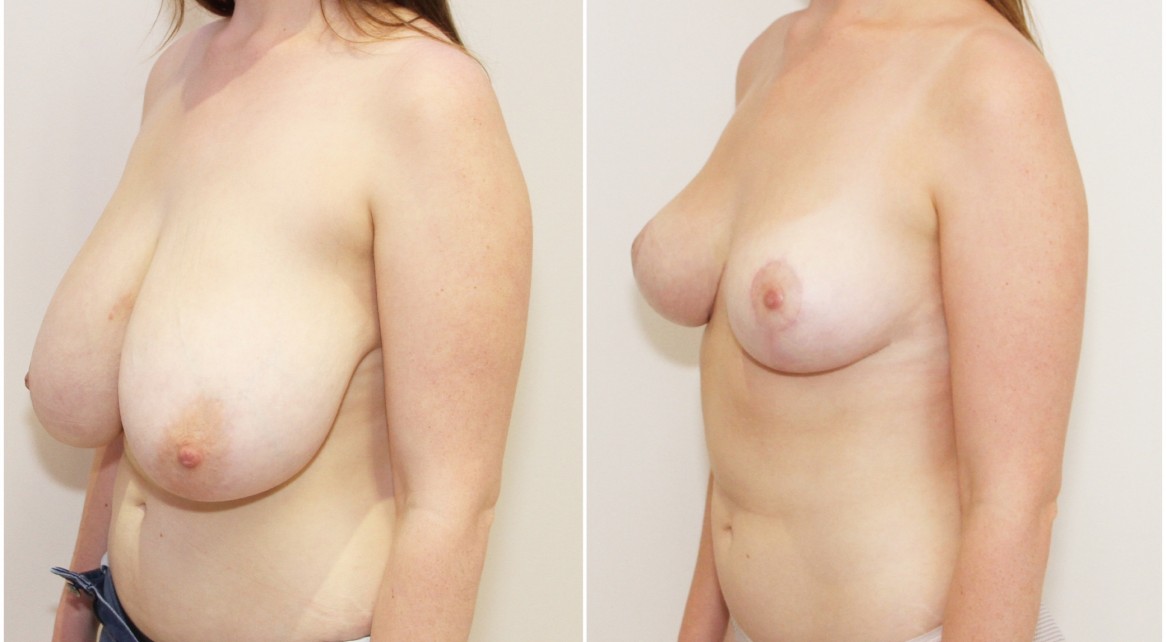 Early 20s, no children, bilateral breast reduction, lift and reshape to restore youthful appearance. Approx. 1000g of breast tissue removed from each side.