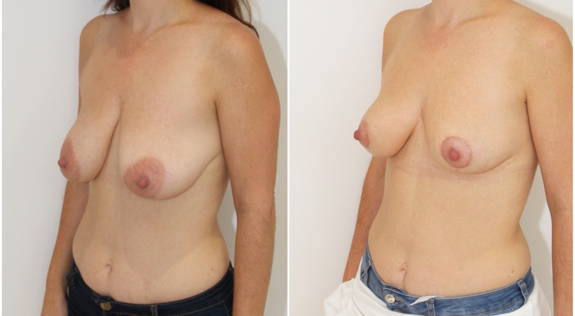 30s, breast lifting and reshaping procedure by Dr Miroshnik using no implants.