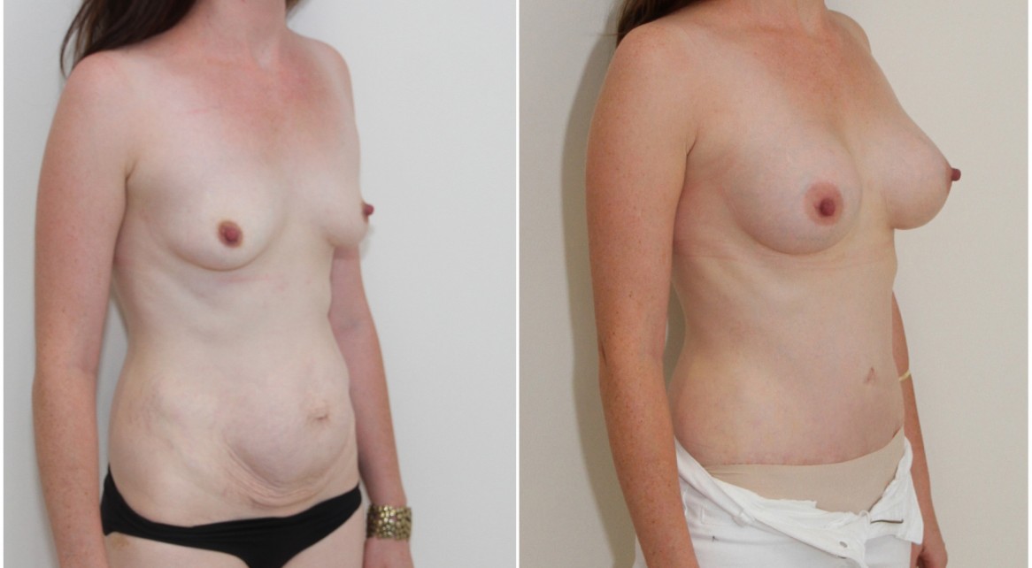 Breast augmentation and shaping with 250g breast anatomics, full tummy tuck to sculpt the abdomen.