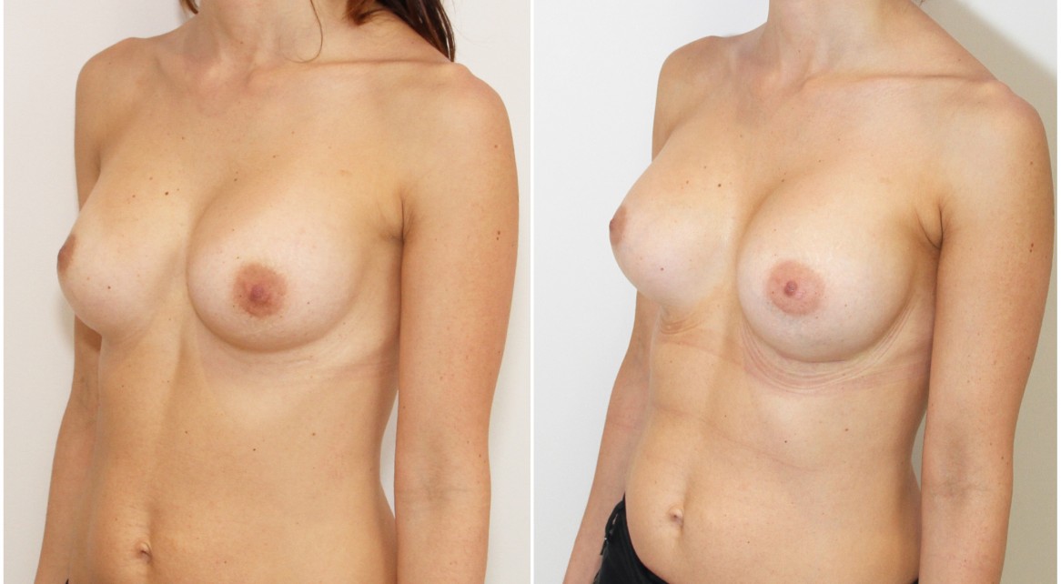20s, breast augmentation revisional surgery removing existing malpositioned, contracted round implants and replacing with submuscular 470g P-URE style anatomics.