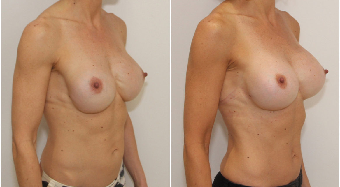 Correction of rippling around cleavage and reshaping lower pole of breast with capsulectomy, internal bra and 555cc anatomical dual plane positioned implants.