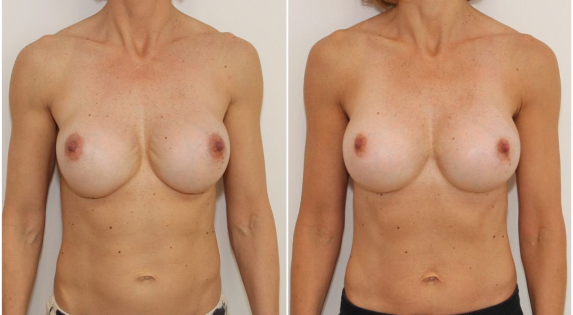 Correction of rippling around cleavage and reshaping lower pole of breast with capsulectomy, internal bra and 555cc anatomical dual plane positioned implants.