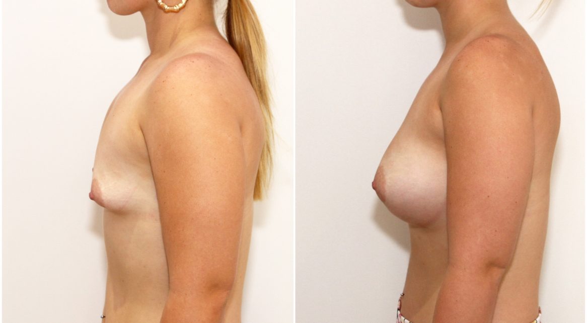 Grade 1 tuberous breasts can be corrected without periareolar incisions like shown here (420cc anatomics).