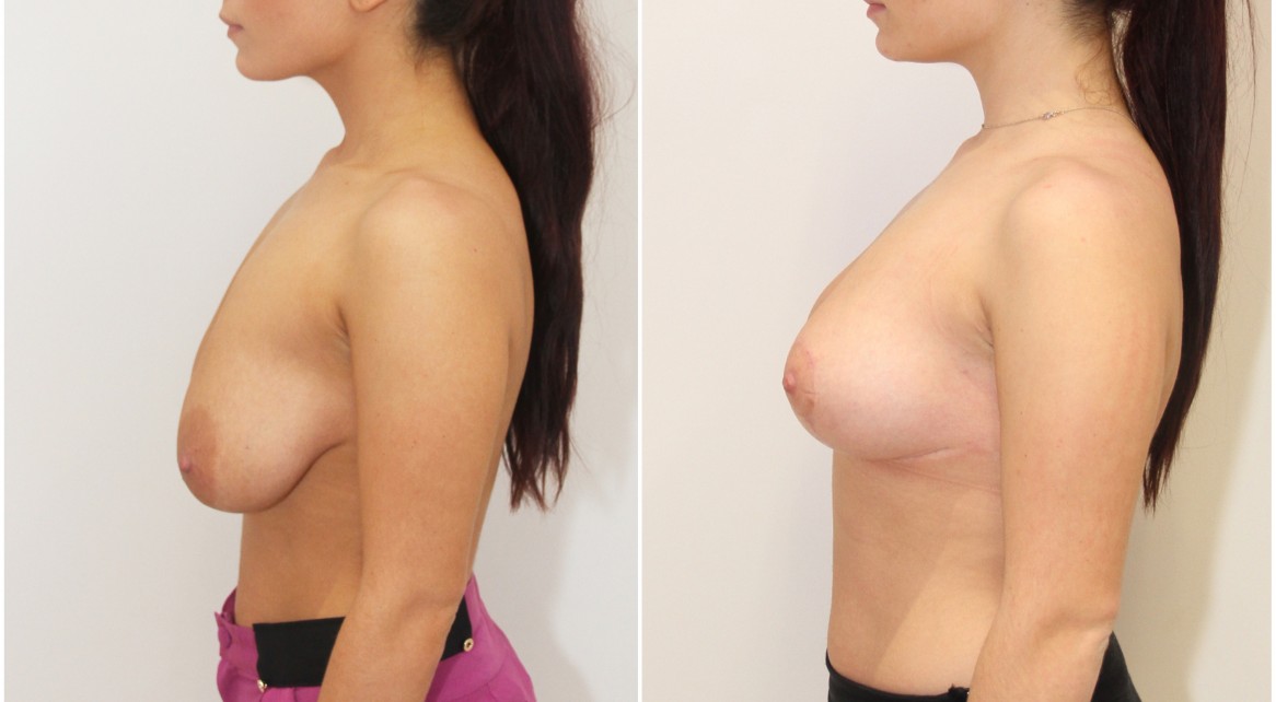 20s, breast lift and reshaping procedure by Dr Miroshnik without the use of implants.