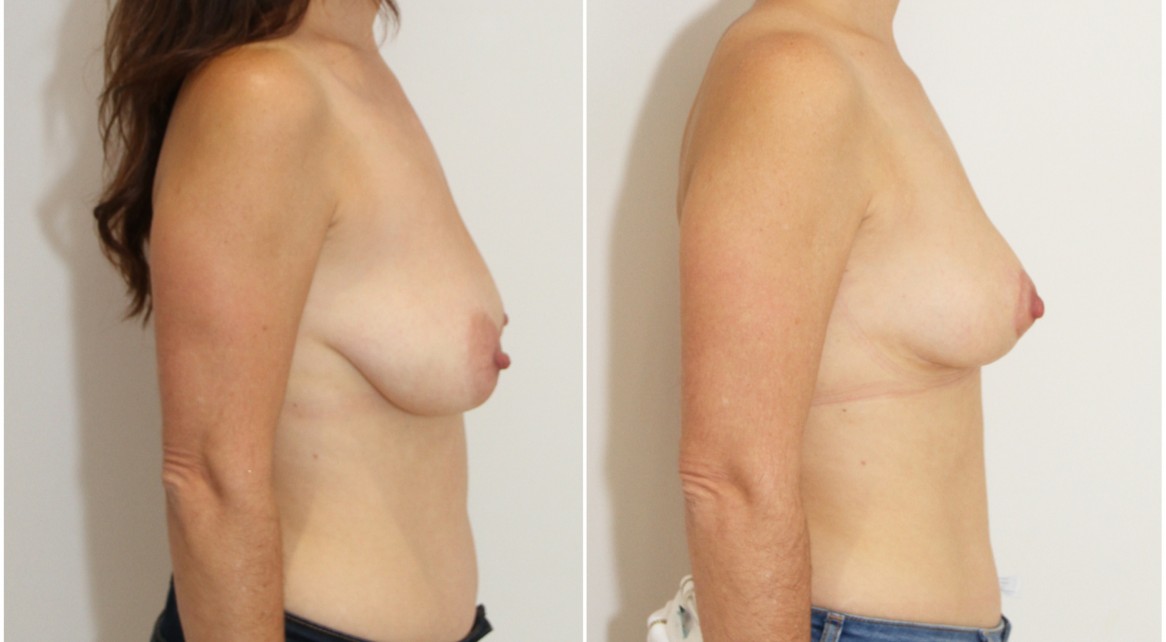 30s, breast lifting and reshaping procedure by Dr Miroshnik using no implants.