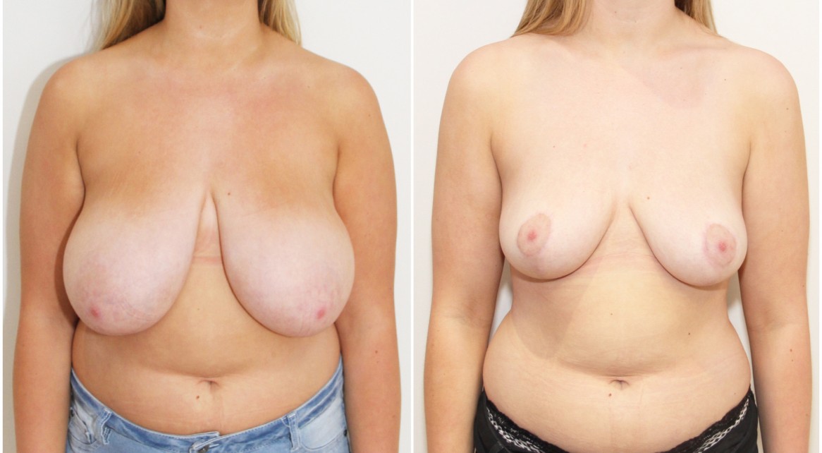 Early 20s, no children, bilateral breast reduction, reshape and lift with removal of 600g of breast tissue per side.