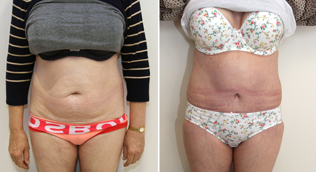 Full tummy tuck to correct abdominal wall laxity and muscle weakness