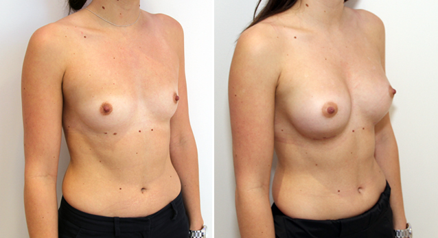 Subtle enhancement with 270g anatomicals, dual plane positioned.