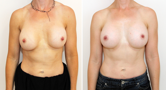 Breast implant removal and repositioning with subfascial placement of 410g anatomical P-URE implants to narrow cleavage and improve symmetry.