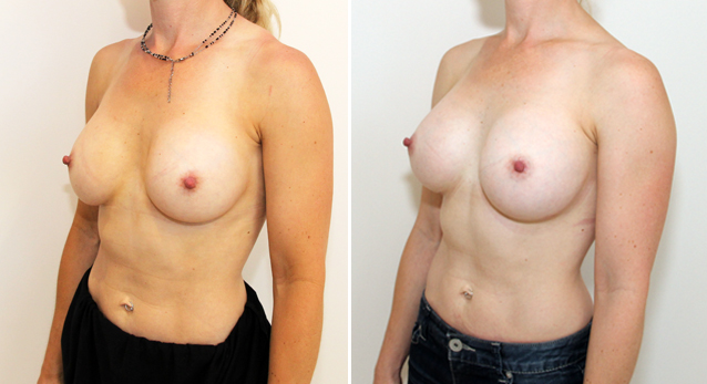 Breast implant removal and repositioning with subfascial placement of 410g anatomical P-URE implants to narrow cleavage and improve symmetry.