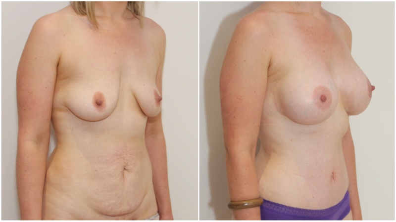 Mummy Makeover with breast augmentation using 420g gel implants, muscle tightening full tummy tuck.